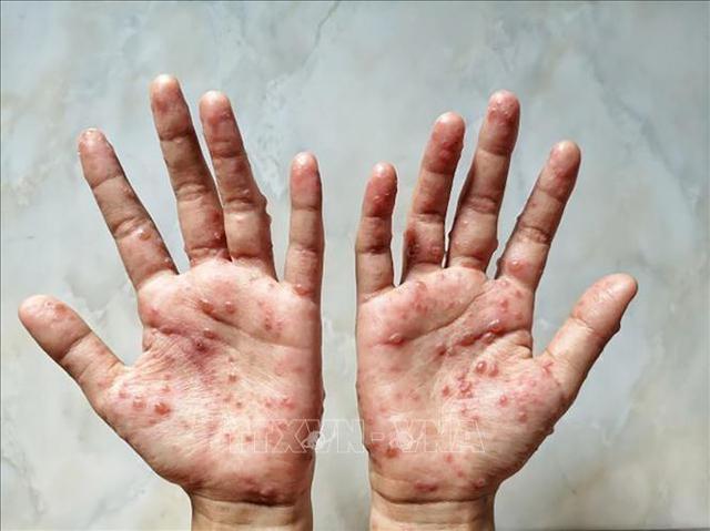 Các ban đỏ nổi trên tay một bệnh nhân mắc đậu mùa khỉ. Ảnh: Shutterstock/TTXVN.